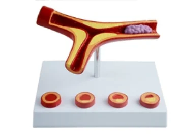 Модель атеросклероза с тромбозом (5 частей) Продвинутый тренажер для обучения медицинским навыкам анатомии человека.
